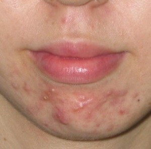 adult acne 
